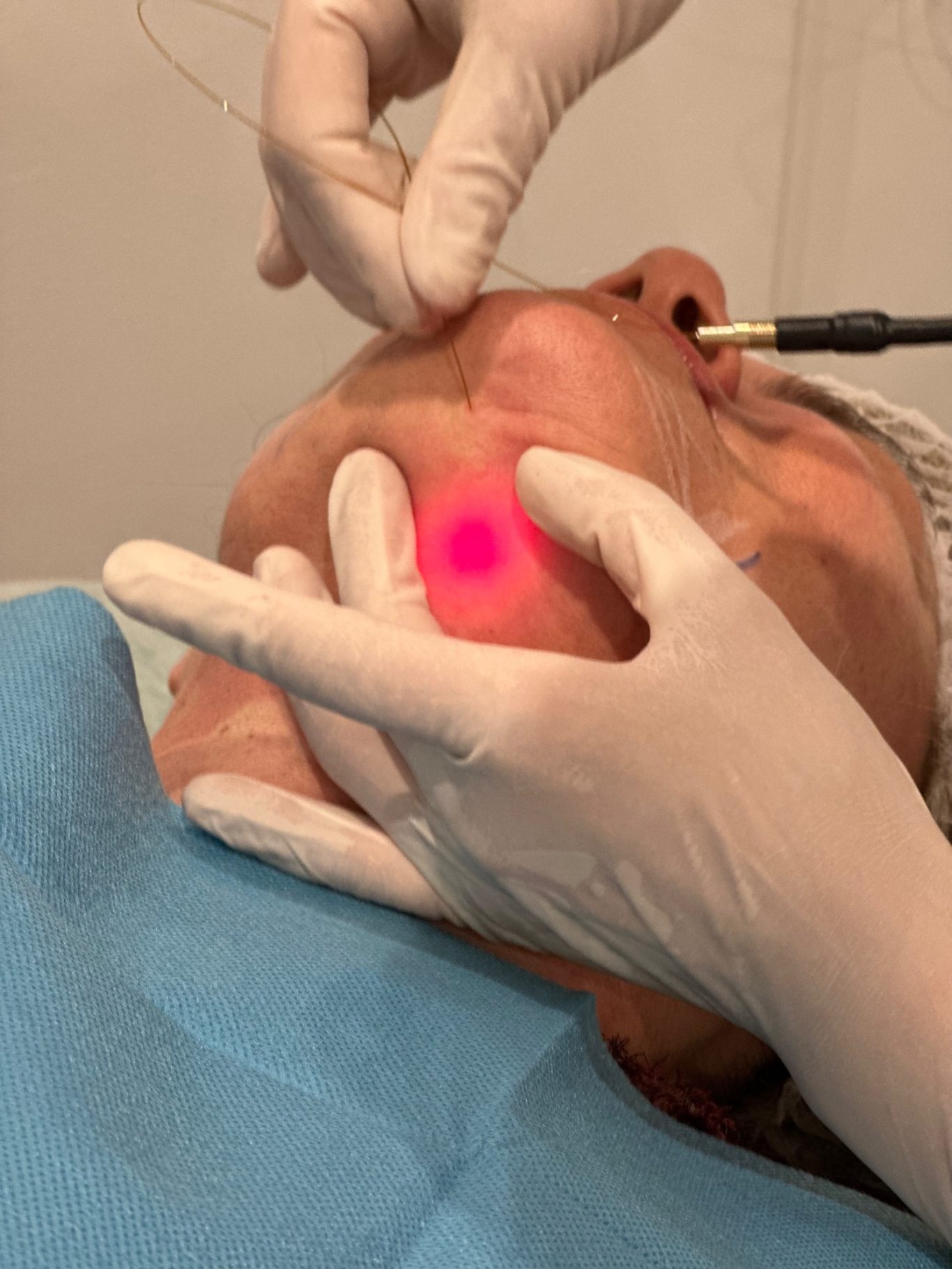 Endolift Endolift rejuvenecimiento y mejora la calidad de la piel y la firmeza